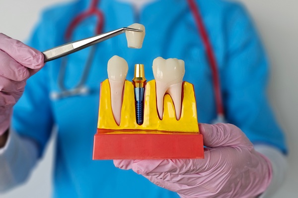 How Dental Implants Slow Down And Prevent Bone Loss