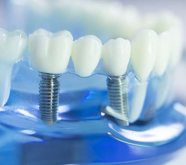 Johnson City Dental Implants