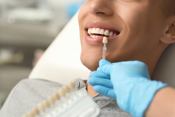 Signs That It Is Time To Replace Your Dental Veneers