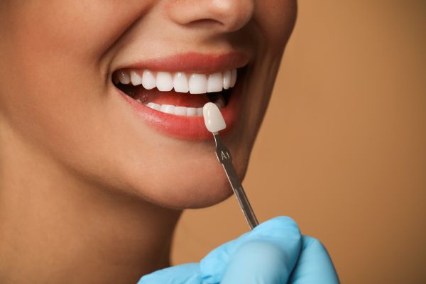 Why Dental Veneers Have Become So Popular In Cosmetic Dentistry