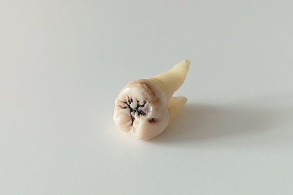 Dos And Don&# ;ts Of Tooth Extraction Aftercare