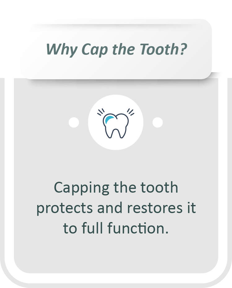 Root canal treatment infographic: Capping the tooth protects and restores it to full function.